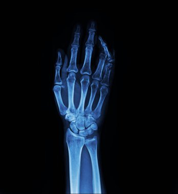 human hand with x-ray image