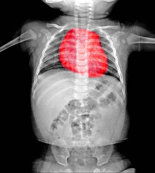 human heart anatomy. x-ray.