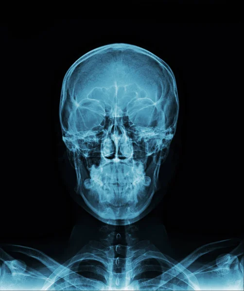 x-ray of human skull with bones and skeleton