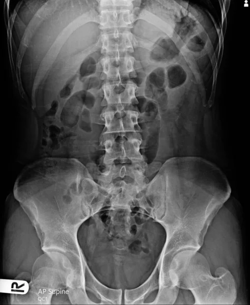 x-ray scan of the spine of the patient