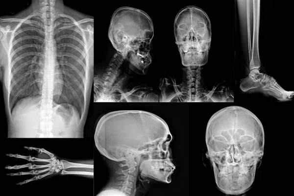 Collection X-ray of human for medical