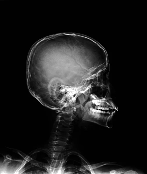 X-ray normal skull and cervical spine . Lateral view .