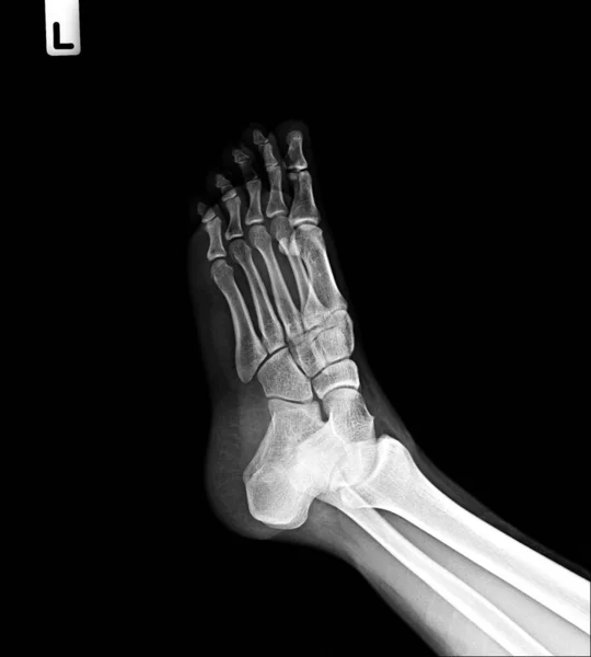X-ray foot AP and oblique view