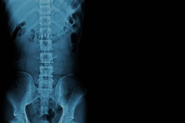 X-ray image of a normal human spine.