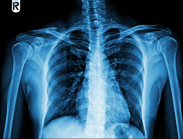 human bones, x-ray. medical concept.