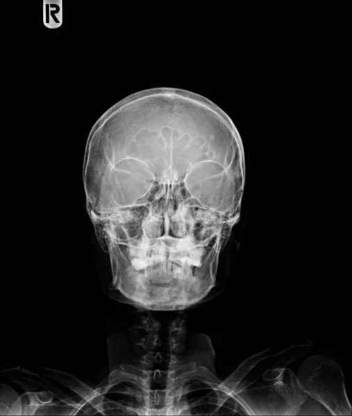 Caveira Raios Mostra Crânio Humano Normal — Fotografia de Stock
