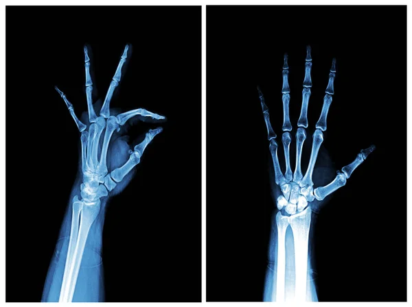 X-ray of Hands  front and oblique view. Normal human hands.