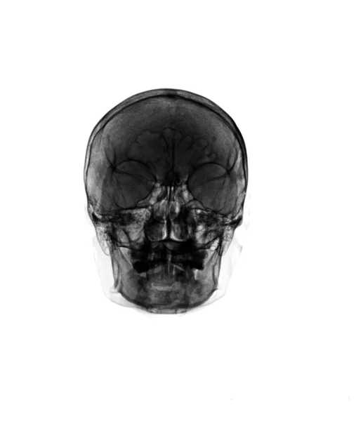 Caveira Raios Mostra Crânio Humano Normal — Fotografia de Stock