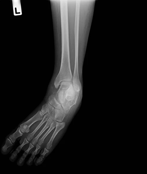 human foot anatomy-joint-bones, joints, medicine, x-bone