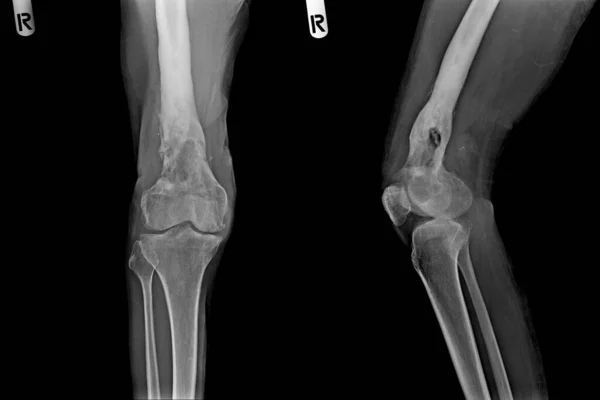 黒い背景の骨のオスの足のX線 クローズアップ 医療の概念 — ストック写真