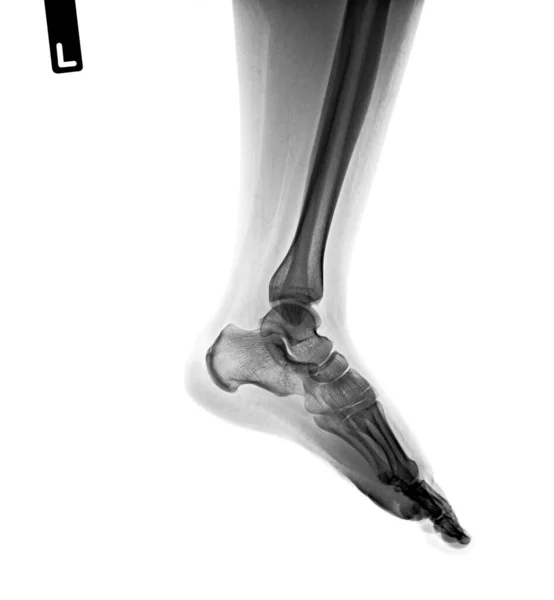 Ανθρώπινα Οστά Και Πόνος Στα Πόδια Εικονογράφηση — Φωτογραφία Αρχείου