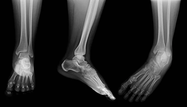 Ανθρώπινα Οστά Και Πόνος Στα Πόδια Εικονογράφηση — Φωτογραφία Αρχείου