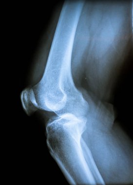 Siyah arka planda bir hastanın x-ray görüntüsü