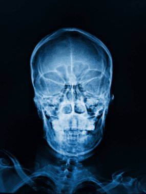 X-ray kafatası ve tıbbi yüzlü insan kemikleri.