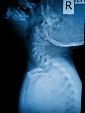 x-ray of the spine of the heart