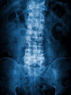insan omurga röntgeni