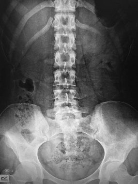 x-ray scan of the spine of the patient