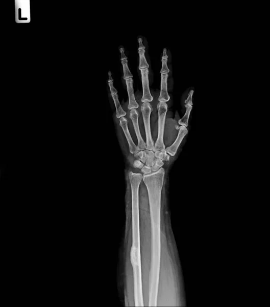 Рентгенівська Рука Плівки Показує Нормальну Людську Руку — стокове фото