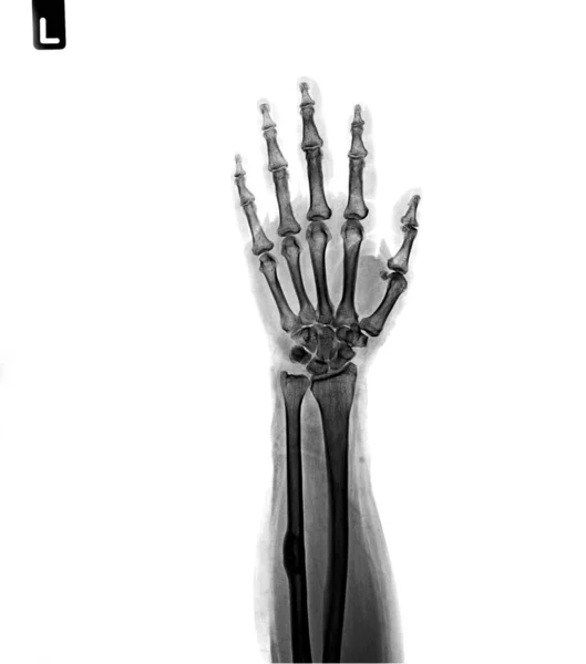 Film Ray Hand Show Normal Human Hand — Stock Photo, Image