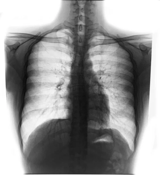 Рентген Человека Больнице Человеческая Грудь — стоковое фото