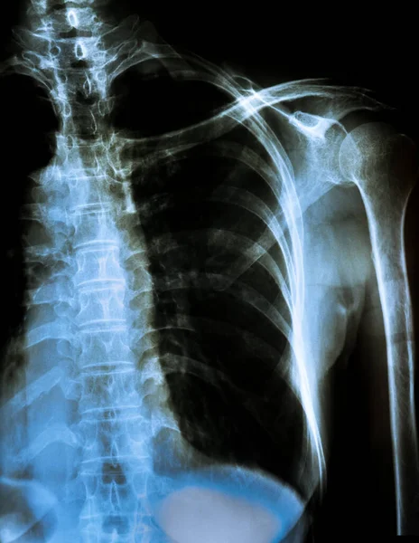 Röntgen Människans Ryggrad Isolerad Svart Och Vit Bakgrund — Stockfoto