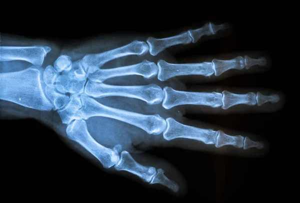 Ανθρώπινα Χέρια Ιατρικό Εξοπλισμό Οστό — Φωτογραφία Αρχείου