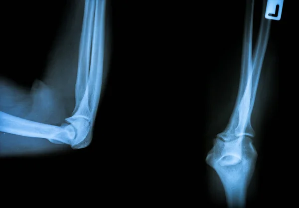 Рентгенівські Промені Рук Пацієнта Чоловічої Статі Крупним Планом — стокове фото
