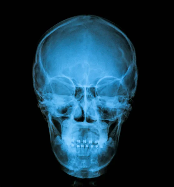 Human Skull Ray Image — Fotografia de Stock