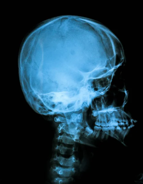 人类脊椎X光检查 — 图库照片
