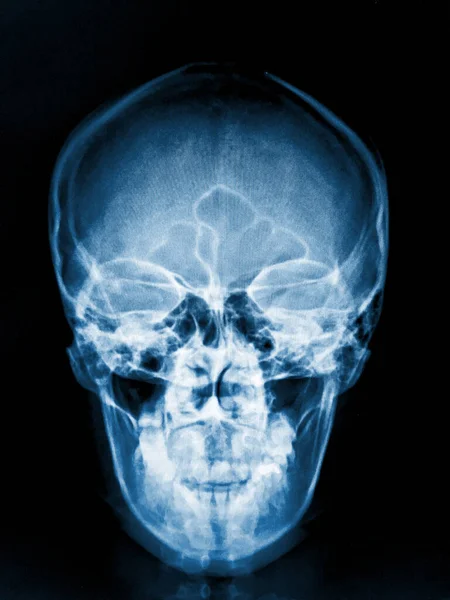 人体骨骼X光 — 图库照片