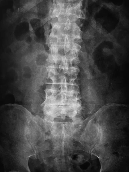 Ray Spine Patient Black Background — Stock Photo, Image