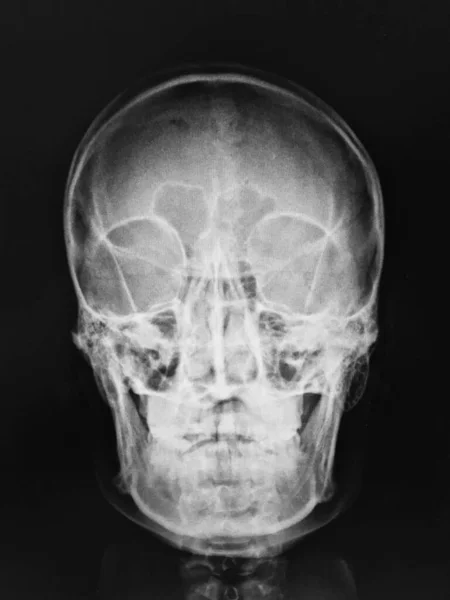 Anatomia Crânio Humano Raio — Fotografia de Stock