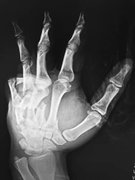 Χέρι Ακτινογραφία Εικόνας Των Ανθρώπινων Χεριών — Φωτογραφία Αρχείου