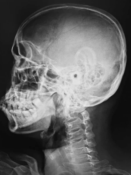 Menneskelig Hjernens Anatomi Røntgen – stockfoto