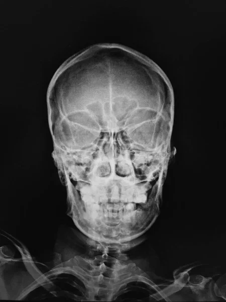 Anatomia Crânio Humano Raio — Fotografia de Stock