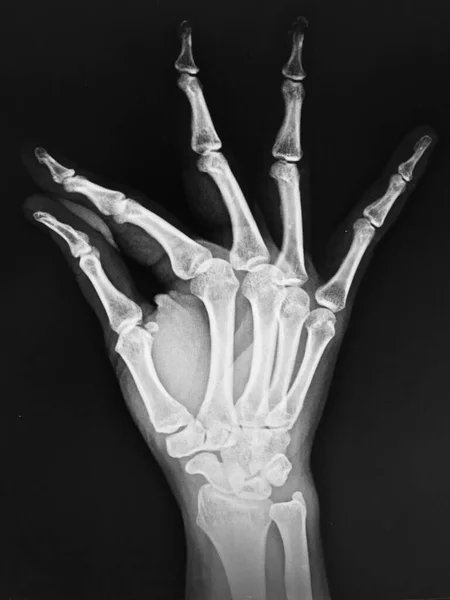 Mão Humana Raio — Fotografia de Stock