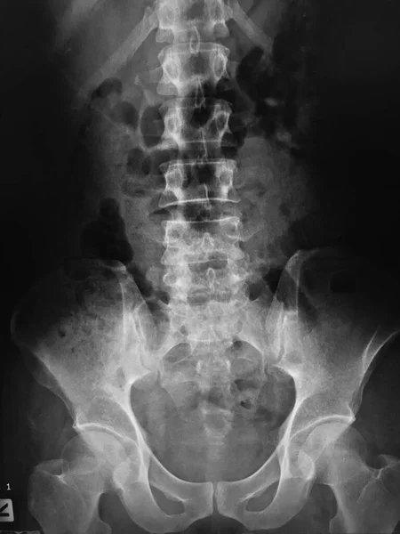 Ray Human Spine — Stock Photo, Image