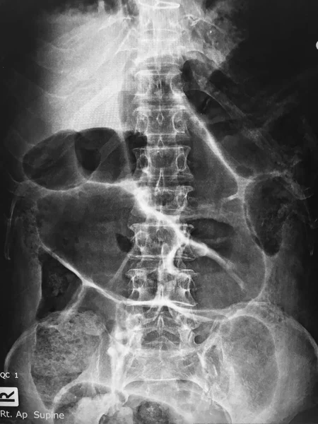 Nahaufnahme Des Menschlichen Körpers Mit Röntgenaufnahme Der Wirbelsäule — Stockfoto