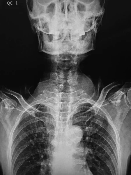 医学スキャンX線肺 黒と白のX線 — ストック写真