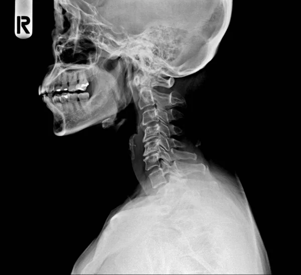 射线头骨和颈椎侧位 — 图库照片