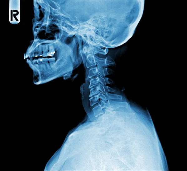 Film Ray Skull Cervical Spine Lateral View — Stock Photo, Image