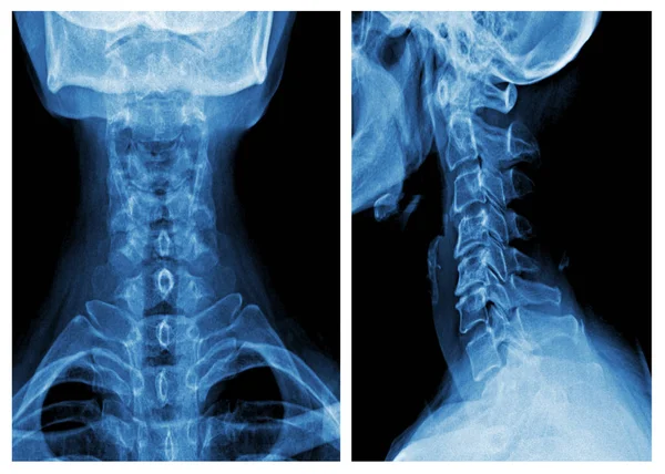 stock image X-ray image photo of human neck