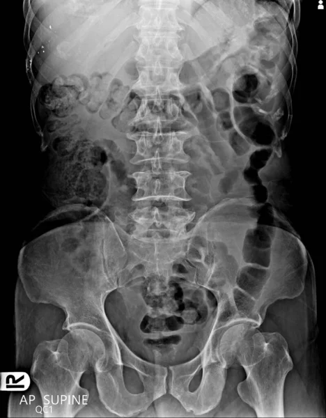 Ray Abdomen Antero Posterior Radiography — Stock Photo, Image