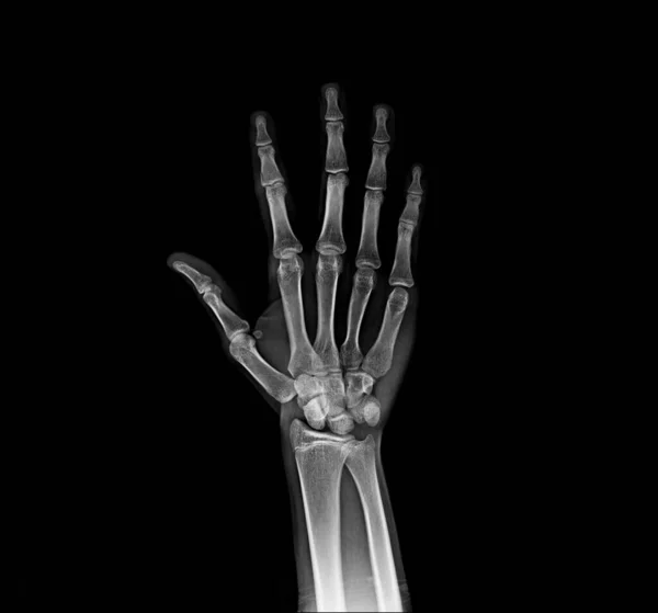 Рентгенівська Рука Перегляд Нормальний — стокове фото