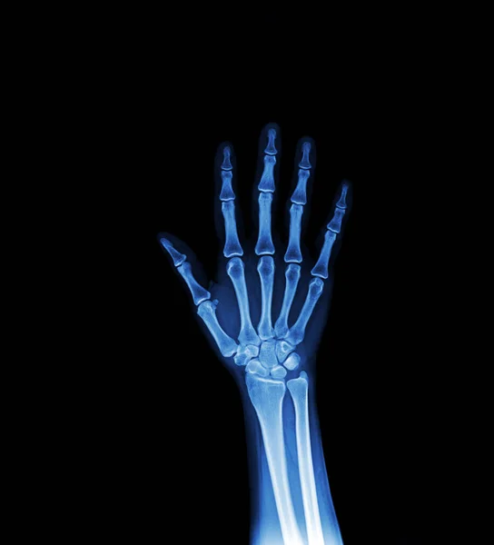 Menschenskelett Hand Hand Röntgenbild Isoliert Auf Schwarz Abbildung — Stockfoto