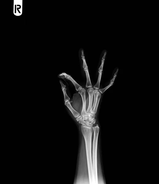 人間の指の骨折の手 — ストック写真