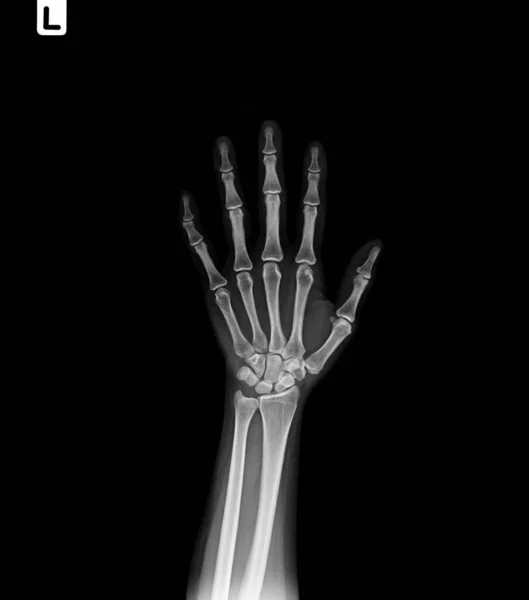 Χέρι Ανθρώπου Ακτίνες — Φωτογραφία Αρχείου