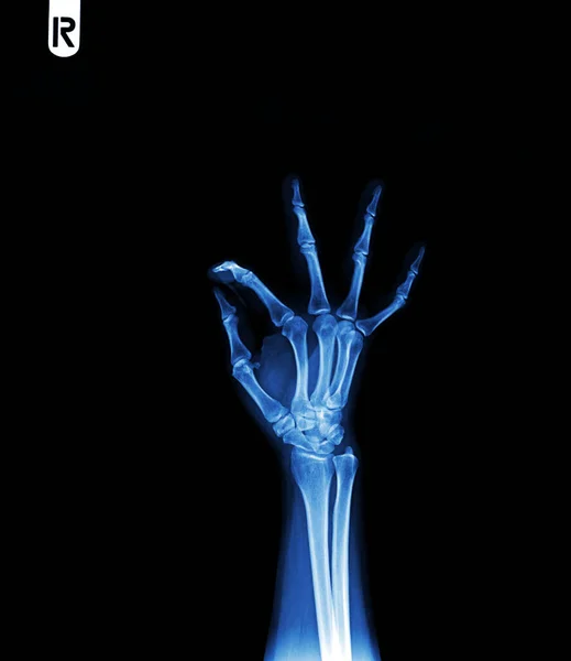 Hand Van Een Mens Hand Röntgenfoto Medische Achtergrond — Stockfoto