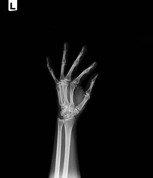 の腕の上にX線と人間の手の腕 医療と健康の概念は — ストック写真