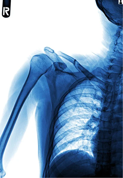 Strahl Der Menschlichen Brust Der Ein Röntgenstrahl Ist — Stockfoto